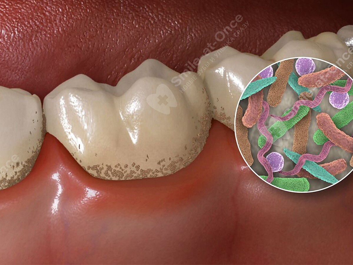 Пародонтит: чем опасны болезни десен и почему имплантация зубов –  единственный способ восстановить зубы при таких проблемах? - KP.RU