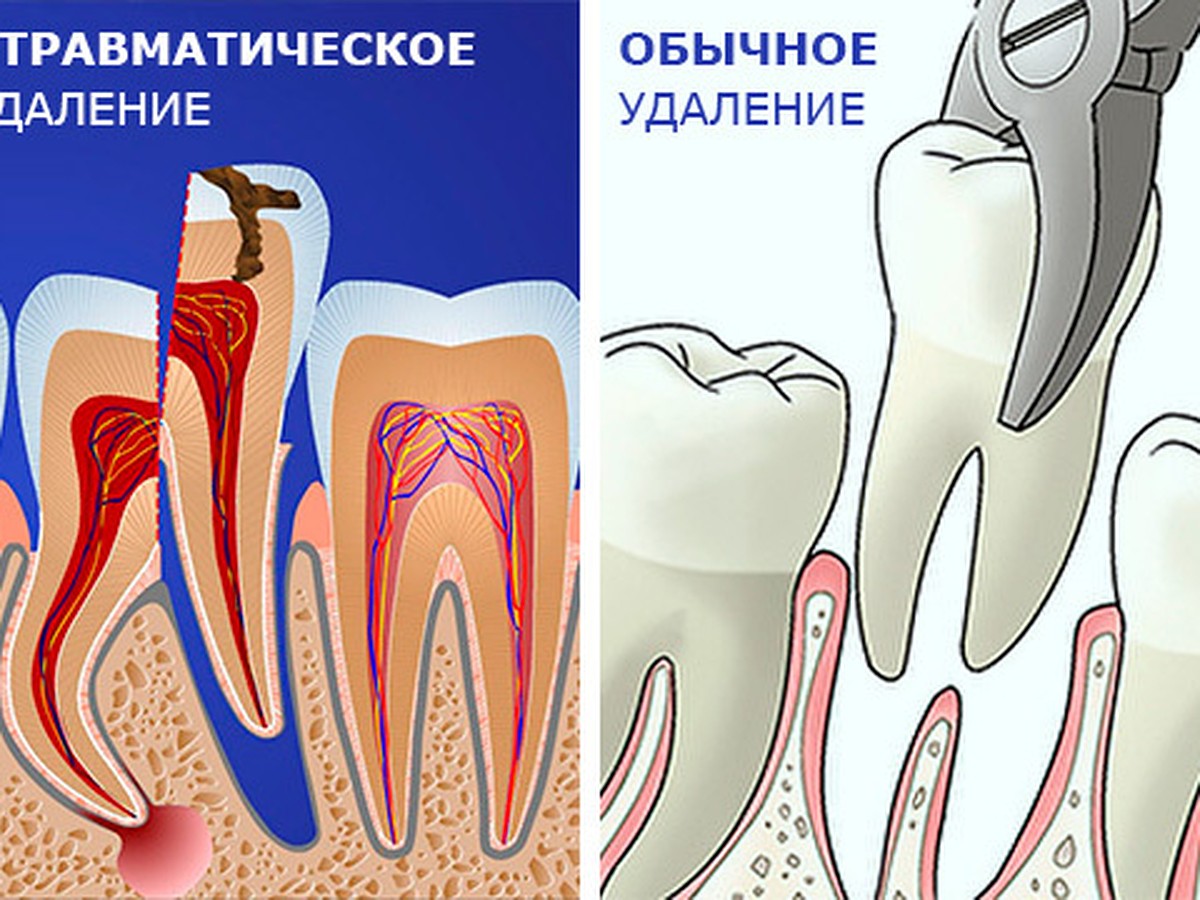Атравматическое удаление зубов: зачем оно нужно? - KP.RU