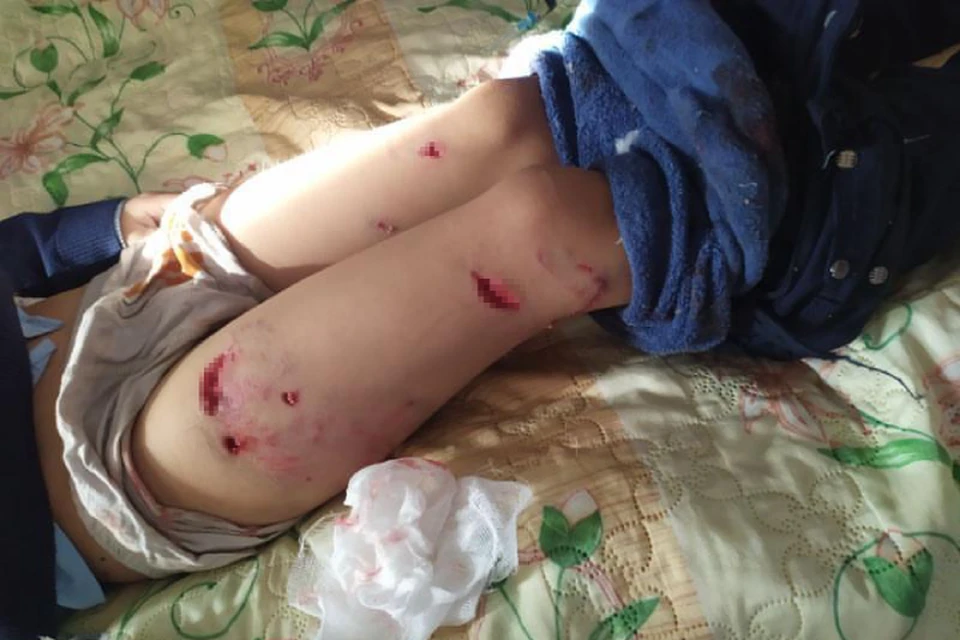В мясо изорвали ноги и голову: свора собак растерзала 7-летнего мальчика в Бурятии