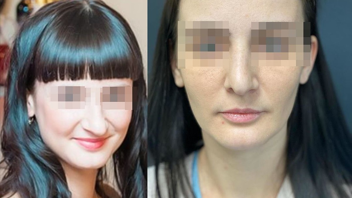 Асимметрия лица. Колумелла носа ринопластика. Септопластика искривление носовой перегородки. Септотомия носовой перегородки что это. Почему разные ноздри.