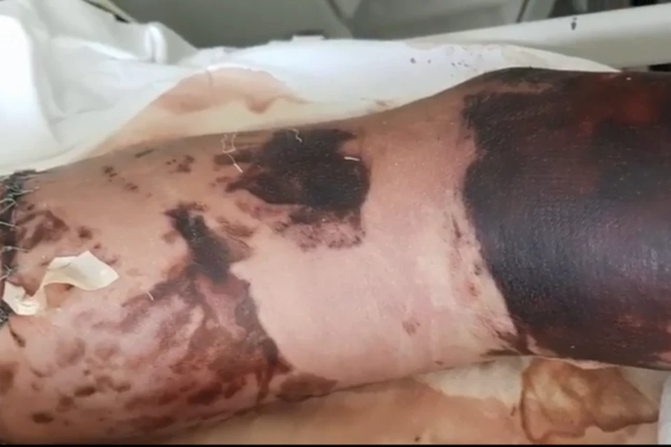 Кузбасские хирурги пришили пострадавшему в ДТП оторванную руку. Фото: Кузбасская клиническая больница/ Instagram