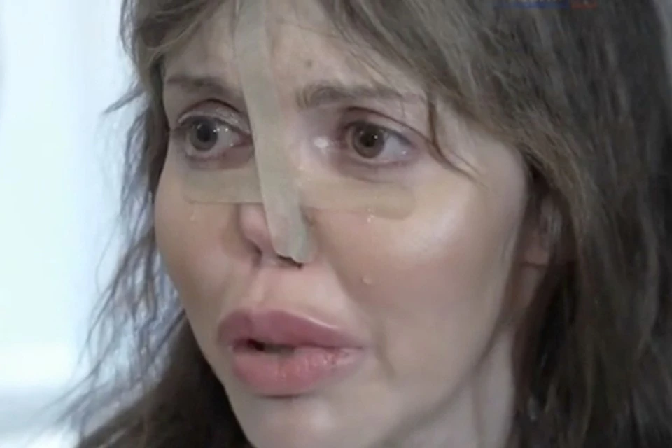 Алиса потеряла былую красоту, ее нос практически провалился. Фото: кадр видео.