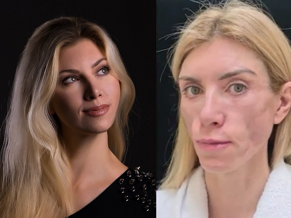 Юлия франц до и после пластики фото