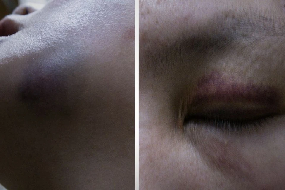 Волонтеры опубликовали якобы раны на лице женщины, попавшей в рабство. Фото: организация "Альтернатива"