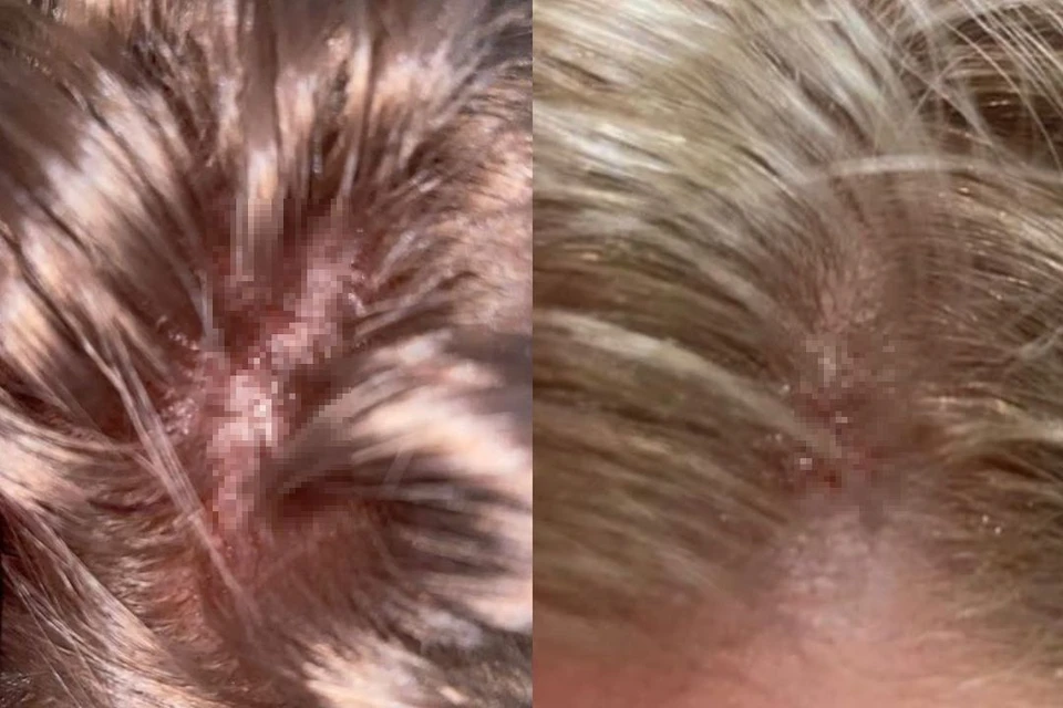 Выпадение волос после окрашивания: решаем проблему