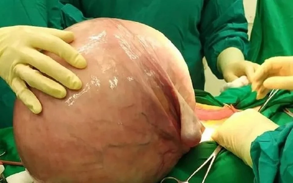 46-летней пациентке удалили запущенную миому матки весом более 11 кг. Фото: пресс-служба МЗ УР