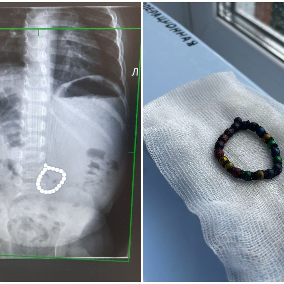 В Челябинской области двухлетний ребенок проглотил браслет из 20 магнитов -  KP.RU