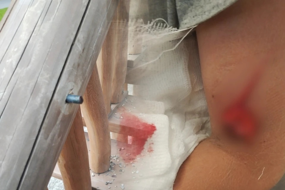 24 июля ребенок серьезно травмировался на детской площадке в Лесопарке из-за торчащего крепежа.