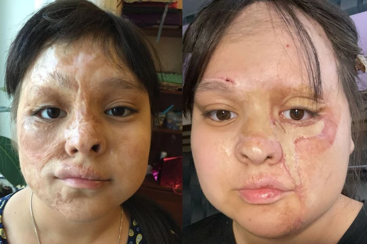 Хирурги подарили новое лицо школьнице, которая пострадала от горящей свечи