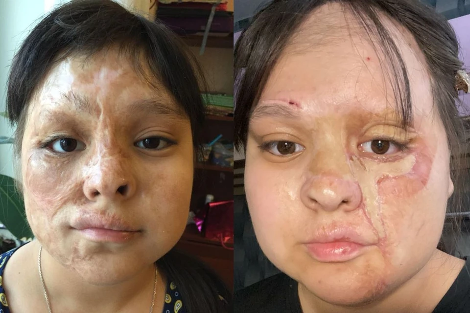 Лицо Нуркуз до операции (фото слева) и после операции в 2024 году (фото справа). Фото: предоставлено Бактыгул Абдраевой