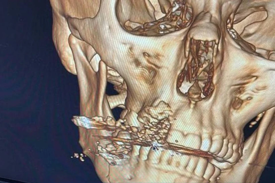 Рентгеновский снимок черепа пострадавшего полицейского. Фото: прокуратура Приморского края