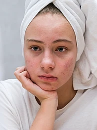 Почему появляется избыточная пигментация кожи
