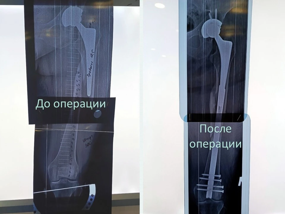 Операция прошла успешно. Фото: министерство здравоохранения по Кировской области.