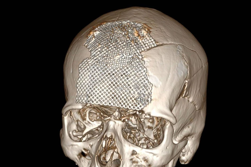 Чтобы создать имплант, специалисты провели 3D-моделирование черепа Фото: t.me/minzdravso
