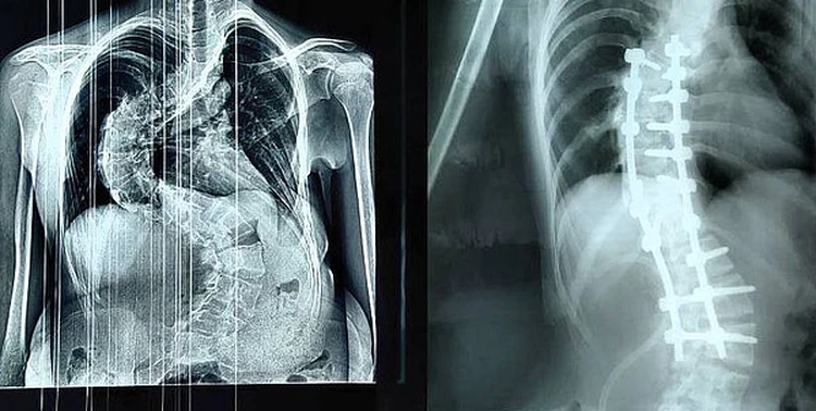 Ходила буквой S: кировские врачи помогли девочке-подростку с тяжелым сколиозом обрести нормальную жизнь