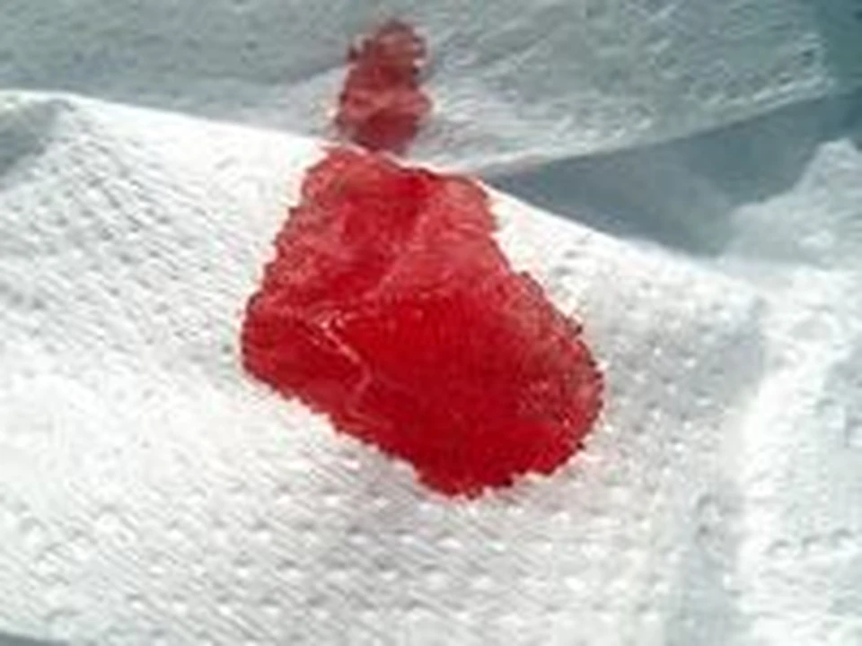 Виды носовых кровотечений по объёму кровопотери