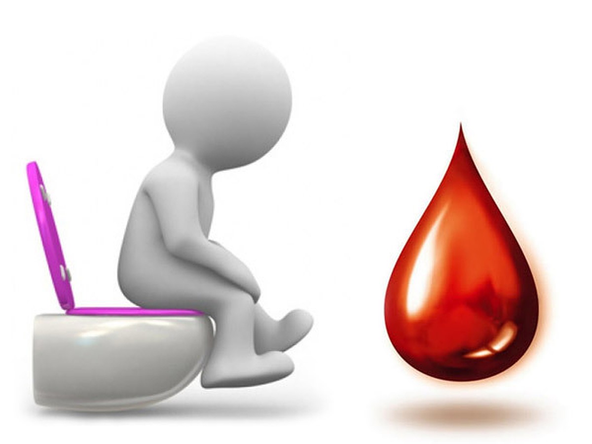 Сгустки крови во время стула