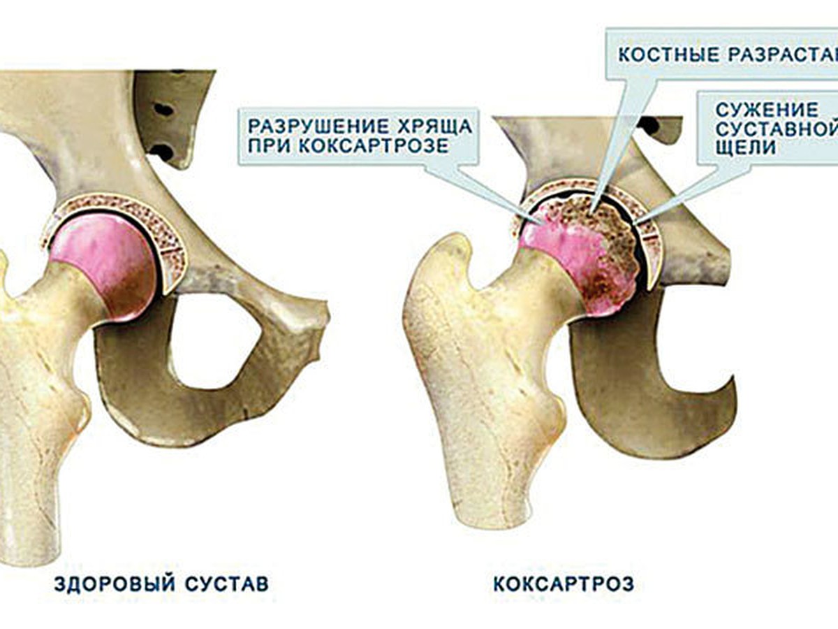 Тазобедренный сустав операция показать. Двусторонний коксартроз тазобедренного сустава 1-2. Коксартроз тазобедренного сустава 2 стадии. Рентген коксартроза тазобедренного сустава 3 степени. Коксартроз эндопротезирование тазобедренного сустава.