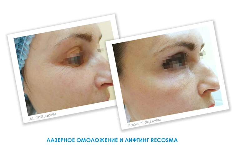 Рекосма лица отзывы: лазерное омоложение и лифтинг без операции - ЛИНЛАЙН отзывы