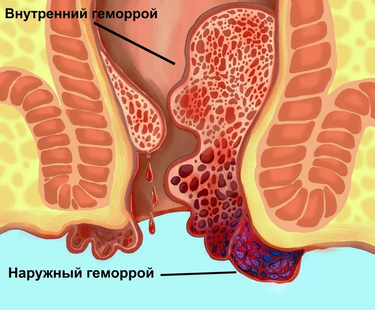 Все, что нужно знать об операции по удалению геморроя