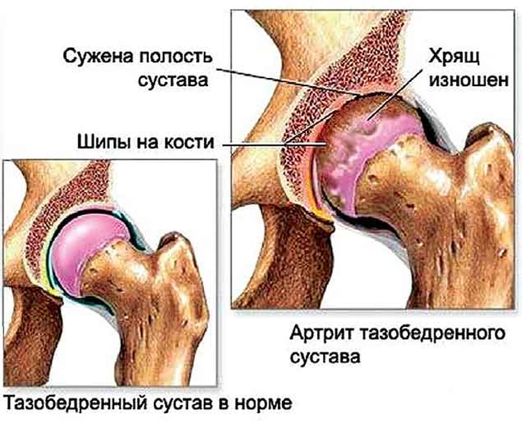 Компьютерная томография тазобедренного сустава